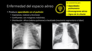 Enfermedad del espacio aéreo
• Produce opacidades en el pulmón
• Esponjosas, nubosas y brumosas
• Confluentes con márgenes indistintos.
• Distribución difusa (edema pulmonar) o localizado (neumonía segmentaria o lobar)
Se caracteriza por:
• Opacidades
pulmonares
• Broncograma aéreo
• Signo de la silueta
 