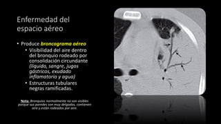 Enfermedad del
espacio aéreo
• Produce broncograma aéreo
• Visibilidad del aire dentro
del bronquio rodeado por
consolidación circundante
(líquido, sangre, jugos
gástricos, exudado
inflamatorio y agua)
• Estructuras tubulares
negras ramificadas.
Nota: Bronquios normalmente no son visibles
porque sus paredes son muy delgadas, contienen
aire y estàn rodeados por aire.
 