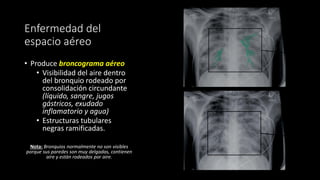 Enfermedad del
espacio aéreo
• Produce broncograma aéreo
• Visibilidad del aire dentro
del bronquio rodeado por
consolidación circundante
(líquido, sangre, jugos
gástricos, exudado
inflamatorio y agua)
• Estructuras tubulares
negras ramificadas.
Nota: Bronquios normalmente no son visibles
porque sus paredes son muy delgadas, contienen
aire y estàn rodeados por aire.
 