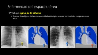 Enfermedad del espacio aéreo
• Produce signo de la silueta
• Cuando dos objetos de la misma densidad radiológica se unen borrando los márgenes entre
ellos.
 