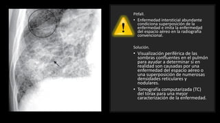 Pitfall.
• Enfermedad intersticial abundante
condiciona superposición de la
enfermedad e imita la enfermedad
del espacio aéreo en la radiografía
convencional.
Solución.
• Visualización periférica de las
sombras confluentes en el pulmón
para ayudar a determinar si en
realidad son causadas por una
enfermedad del espacio aéreo o
una superposición de numerosas
densidades reticulares y
nodulares.
• Tomografía computarizada (TC)
del tórax para una mejor
caracterización de la enfermedad.
 