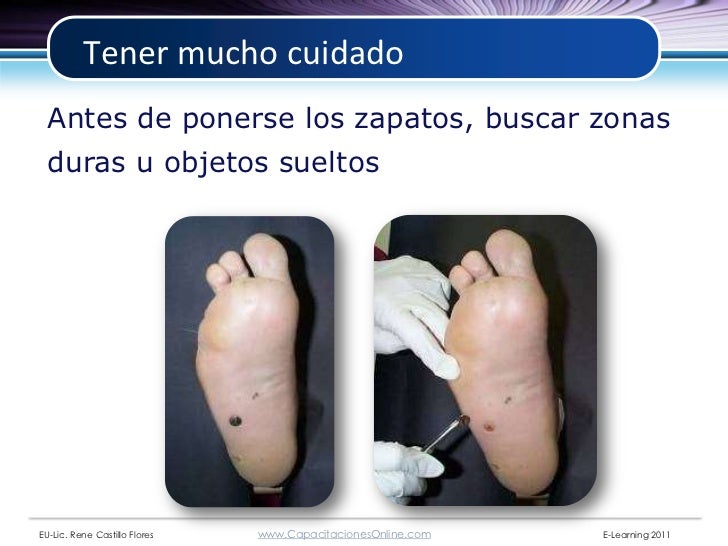 Examen clinico del pie diabetico 2008