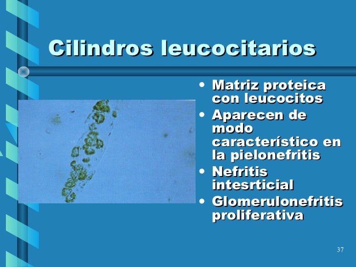 Resultado de imagen para analisis de orina cilindros de orina