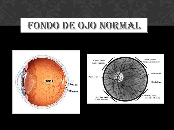 Examen de fondo de ojo