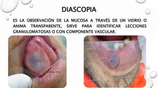 Examen de la mucosa bucal | PPTX
