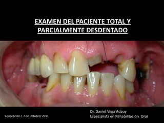 EXAMEN DEL PACIENTE TOTAL Y
PARCIALMENTE DESDENTADO
Dr. Daniel Vega Adauy
Especialista en Rehabilitación OralConcepción / 7 de Octubre/ 2011
 