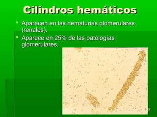Cilindros hemáticos
 Aparecen en las hematurias glomerulares
  (renales).
 Aparece en 25% de las patologías
  glomerulares.




                                            32
 