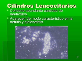 Cilindros Leucocitarios
 Contiene abundante cantidad de
  neutrófilos.
 Aparecen de modo característico en la
  nefritis y pielonefritis.




                                          33
 
