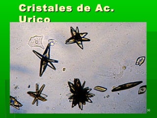 Cristales de Ac.
Urico




                   36
 