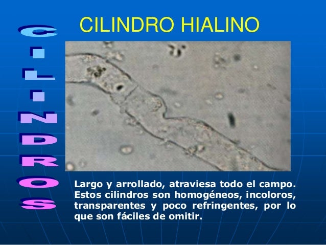 Resultado de imagen para analisis de orina cilindros de orina