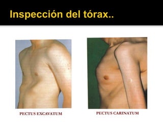 PECTUS EXCAVATUM   PECTUS CARINATUM
 