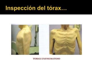 TORAX ENFISEMATOSO
 