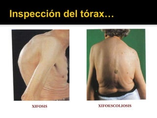 XIFOSIS   XIFOESCOLIOSIS
 