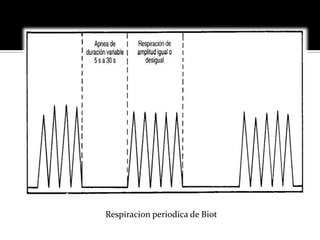 Respiracion periodica de Biot
 