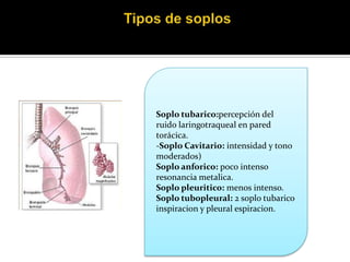 Soplo tubarico:percepción del
ruido laringotraqueal en pared
torácica.
-Soplo Cavitario: intensidad y tono
moderados)
Soplo anforico: poco intenso
resonancia metalica.
Soplo pleuritico: menos intenso.
Soplo tubopleural: 2 soplo tubarico
inspiracion y pleural espiracion.
 