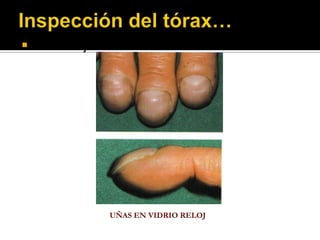    Tronco y extremidades




              UÑAS EN VIDRIO RELOJ
 