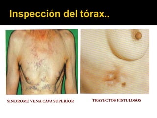 SINDROME VENA CAVA SUPERIOR   TRAYECTOS FISTULOSOS
 