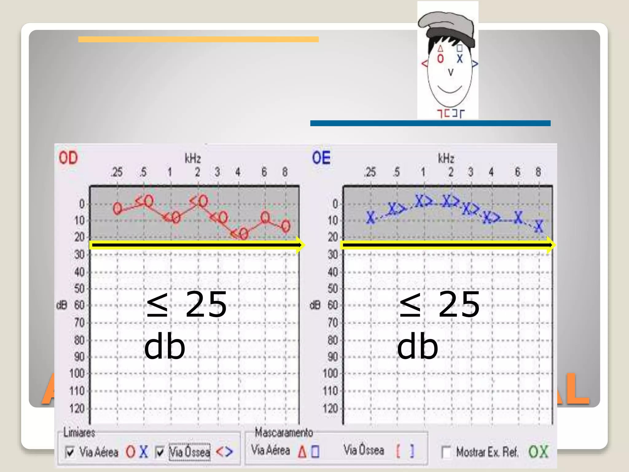 AUDIOGRAMA NORMAL
≤ 25
db
≤ 25
db
 