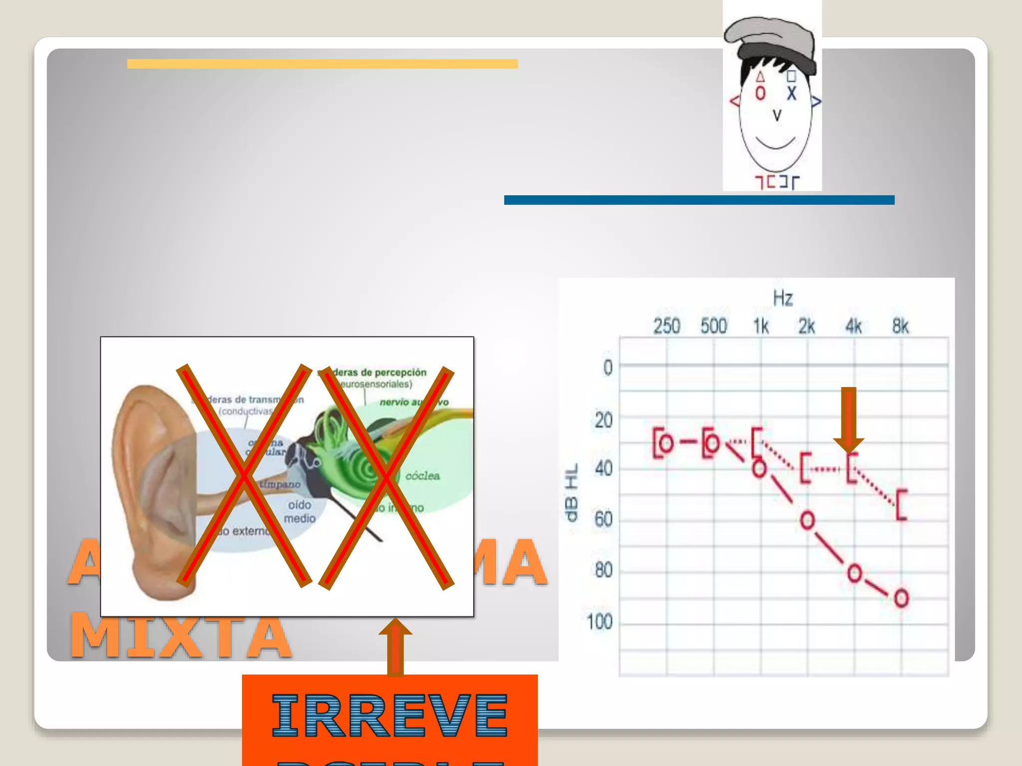 AUDIOGRAMA ANORMAL:
MIXTA
 