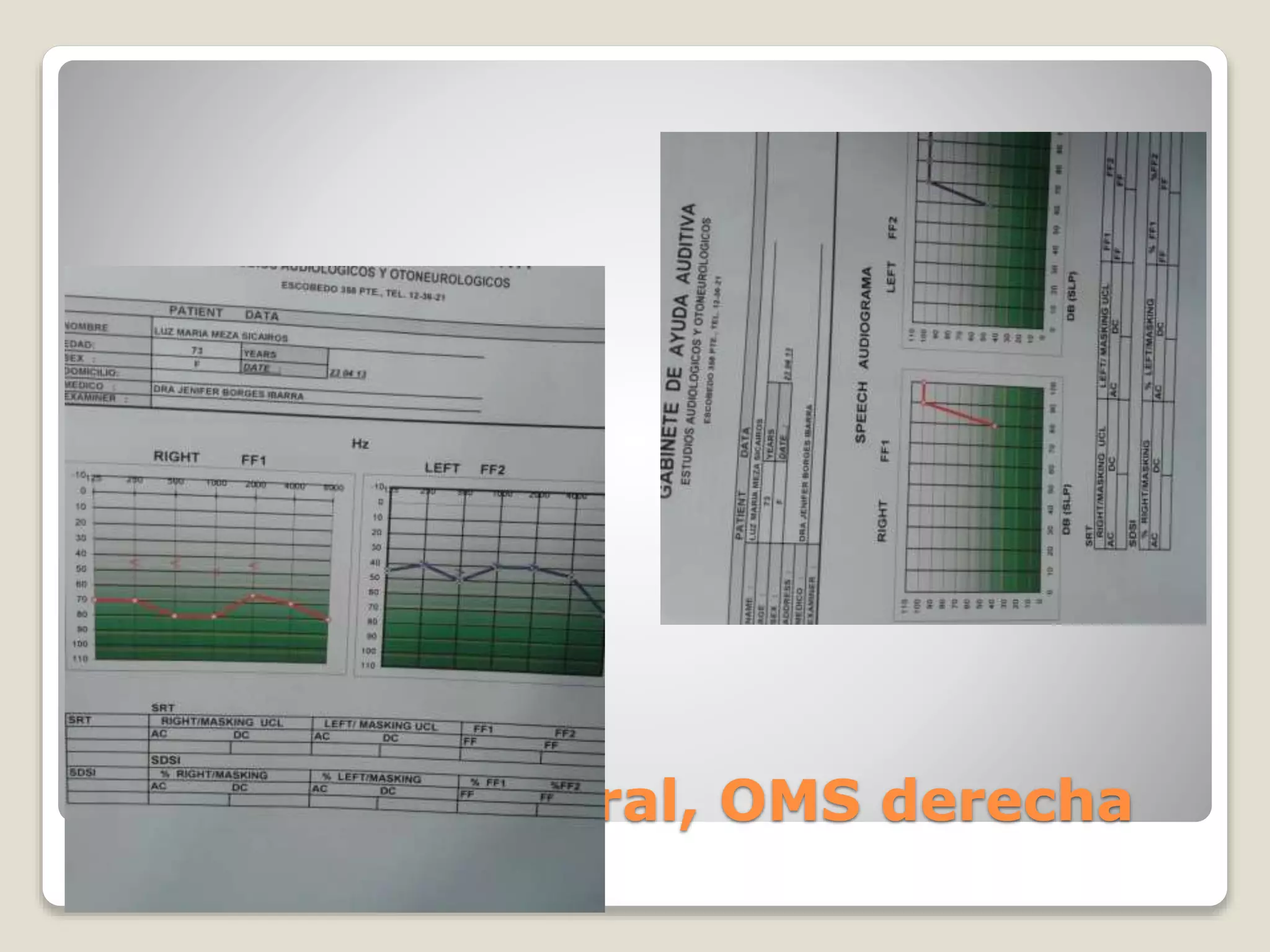 Cortipatia bilateral, OMS derecha
 
