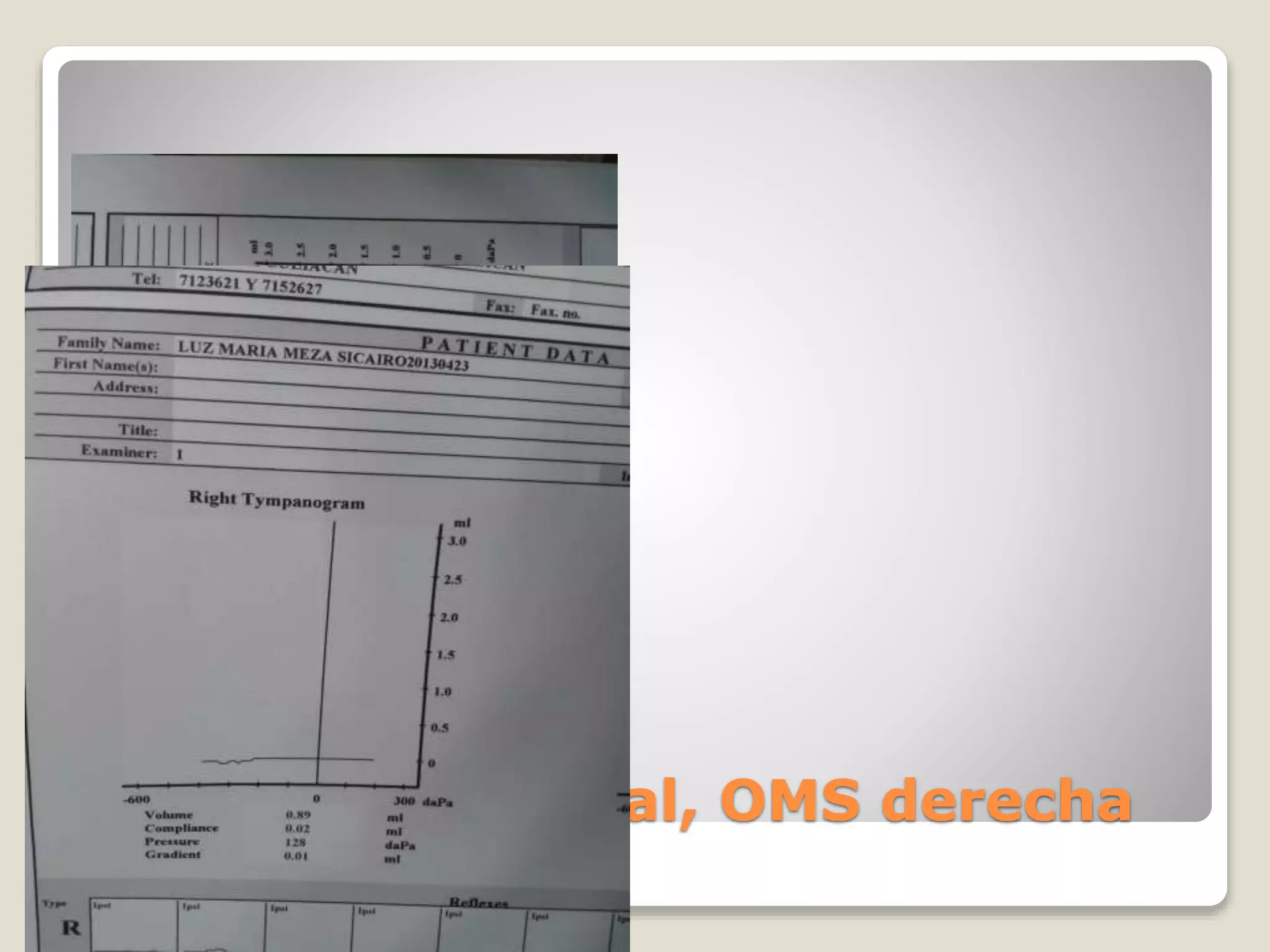 Cortipatia bilateral, OMS derecha
 