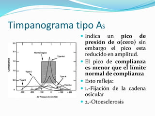 Timpanograma tipo AS
 Indica un pico de
presión de 0(cero) sin
embargo el pico esta
reducido en amplitud.
 El pico de complianza
es menor que el límite
normal de complianza
 Esto refleja:
 1.-Fijación de la cadena
osicular
 2.-Otoesclerosis
 