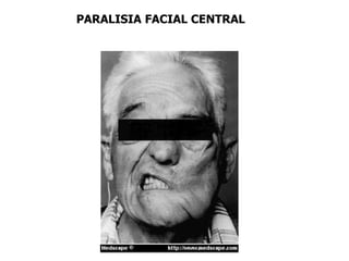 PARALISIA FACIAL CENTRAL
 