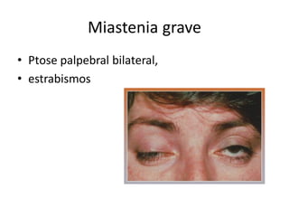 Miastenia grave
• Ptose palpebral bilateral,
• estrabismos
 