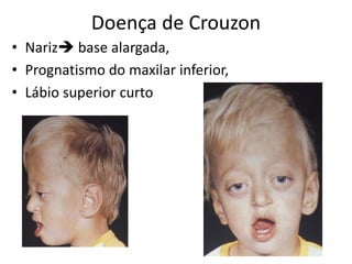 Doença de Crouzon
• Nariz base alargada,
• Prognatismo do maxilar inferior,
• Lábio superior curto
 