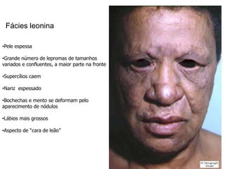 Fácies leonina
•Pele espessa
•Grande número de lepromas de tamanhos
variados e confluentes, a maior parte na fronte
•Supercílios caem
•Nariz espessado
•Bochechas e mento se deformam pelo
aparecimento de nódulos
•Lábios mais grossos
•Aspecto de “cara de leão”
 