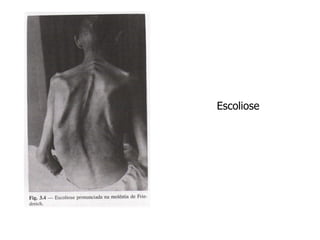 Escoliose
 