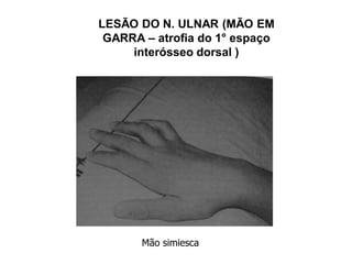 LESÃO DO N. ULNAR (MÃO EM
GARRA – atrofia do 1° espaço
interósseo dorsal )
Mão simiesca
 