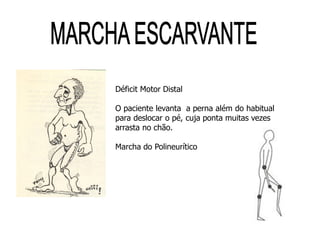 Déficit Motor Distal
O paciente levanta a perna além do habitual
para deslocar o pé, cuja ponta muitas vezes
arrasta no chão.
Marcha do Polineurítico
 