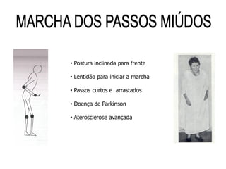 • Postura inclinada para frente
• Lentidão para iniciar a marcha
• Passos curtos e arrastados
• Doença de Parkinson
• Aterosclerose avançada
 