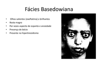 Fácies Basedowiana
• Olhos salientes (exoftalmia) e brilhantes
• Rosto magro
• Por vezes aspecto de espanto e ansiedade
• Presença de bócio
• Presente no hipertireoidismo
 