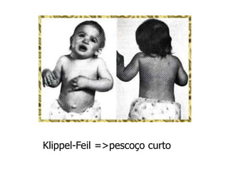 Klippel-Feil =>pescoço curto
 