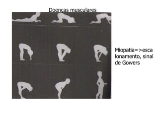 Miopatia=>esca
lonamento, sinal
de Gowers
Doenças musculares
 