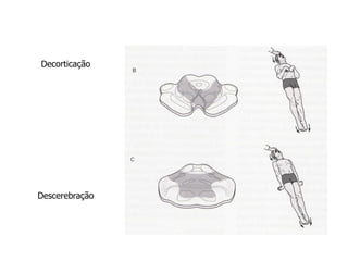 Decorticação
Descerebração
 