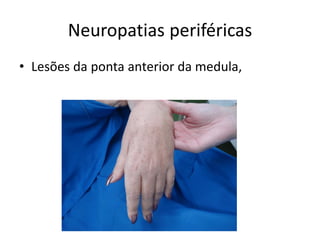 Neuropatias periféricas
• Lesões da ponta anterior da medula,
 