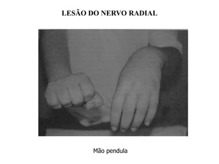 LESÃO DO NERVO RADIAL
Mão pendula
 