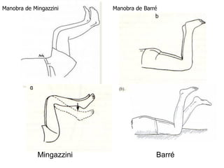 Mingazzini Barré
Manobra de Mingazzini Manobra de Barré
 