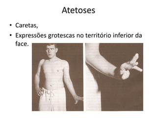 Atetoses
• Caretas,
• Expressões grotescas no território inferior da
face.
 