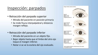 • Retracción del parpado superior
• Mirada del paciente en posición primaria
• Se mide fisura interpalpebral y distancia
margen reflejo.
• Retracción del parpado inferior
• Mirada del paciente en un objeto fijo.
• Bajar objeto hasta que el limbo del otro ojo
toque el margen inferior.
• Notar si se ve la esclera del ojo evaluado.
Inspección: parpados
 