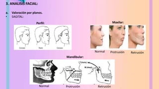 3. ANALISIS FACIAL:
a. Valoración por planos.
• SAGITAL:
Normal Protrusión Retrusión
Perfil: Maxilar:
Mandibular:
Protrusión Retrusión
Normal
 
