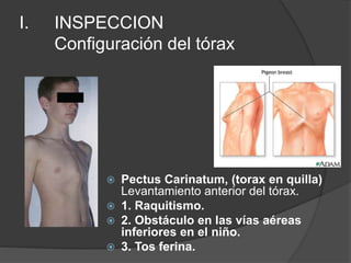 I. INSPECCION
Configuración del tórax
 Pectus Carinatum, (torax en quilla)
Levantamiento anterior del tórax.
 1. Raquitismo.
 2. Obstáculo en las vías aéreas
inferiores en el niño.
 3. Tos ferina.
 
