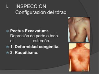 I. INSPECCION
Configuración del tórax
 Pectus Excavatum:.
Depresión de parte o todo
el esternón.
 1. Deformidad congénita.
 2. Raquitismo.
 