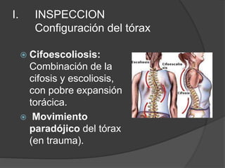 I. INSPECCION
Configuración del tórax
 Cifoescoliosis:
Combinación de la
cifosis y escoliosis,
con pobre expansión
torácica.
 Movimiento
paradójico del tórax
(en trauma).
 