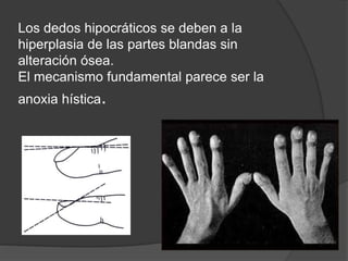 Los dedos hipocráticos se deben a la
hiperplasia de las partes blandas sin
alteración ósea.
El mecanismo fundamental parece ser la
anoxia hística.
 