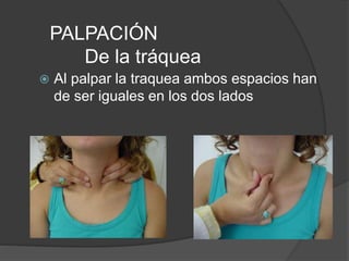 PALPACIÓN
De la tráquea
 Al palpar la traquea ambos espacios han
de ser iguales en los dos lados
 