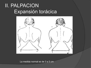 II. PALPACION
Expansión torácica
La medida normal es de 3 a 5 cm
 